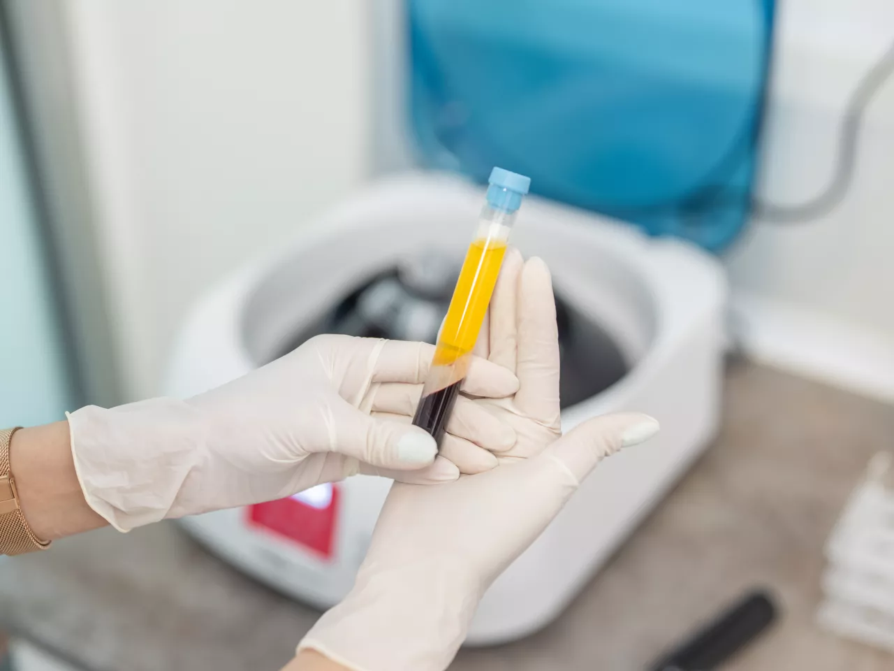 Eine Person mit Einweghandschuhen hält präsentierend ein Röhrchen in beiden Händen. In diesem ist eine Flüssigkeit zu sehen. Das untere Drittel der Flüssigkeit ist dunkelrot und die obene zwei Drittel sind gelb. Zu sehen ist hier Blut, nachdem es zentrifugiert wurde und dadurch in Blutplättchen und Blutplasma geteilt wurde.